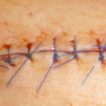 Lacerations & Avulsions